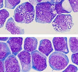 Top: Acute myeloid leukemia cells presenting anomalies in standard growth conditions. Below: Acute myeloid leukemia cells preserving their leukemic cell features following in vitro culture with the two chemical molecules referred to in the study cited.